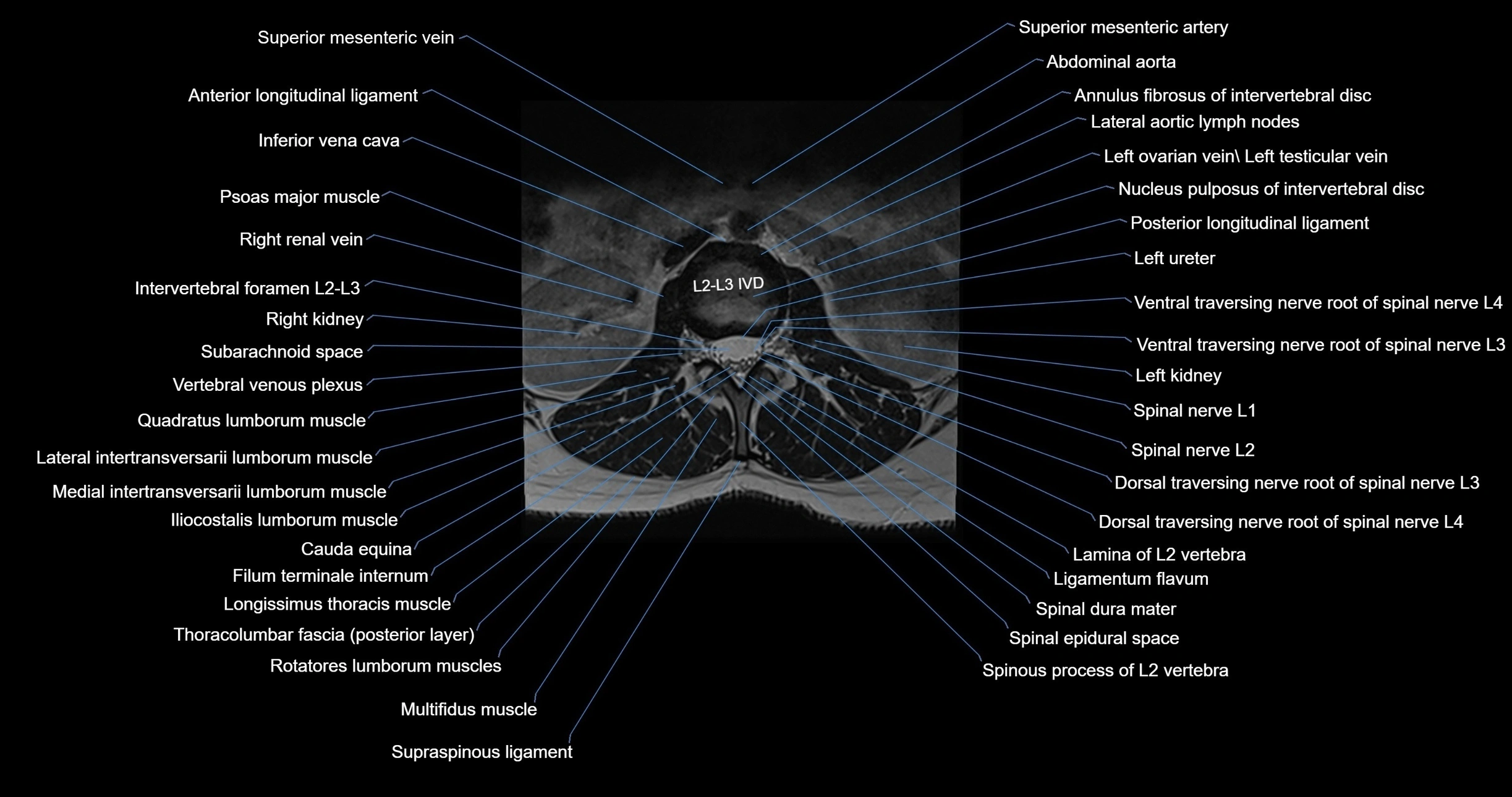 MRI lumbar spine axial cross sectional anatomy 3T radiology  image-img-00001-00018.webp